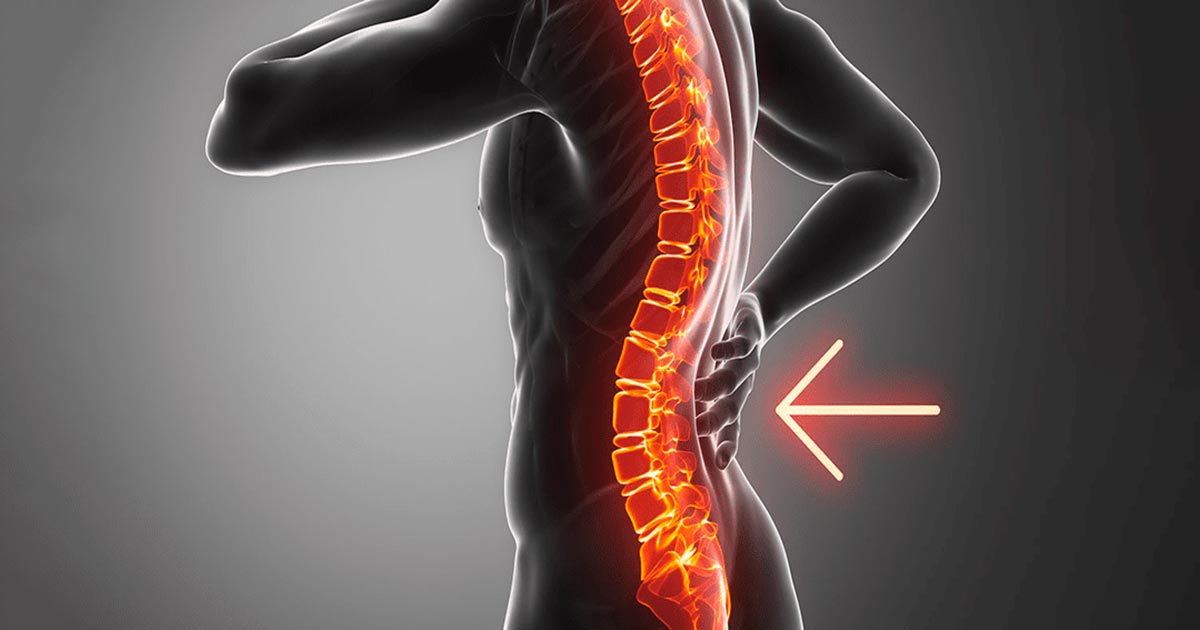 A hiperlordose lombar é a causa das suas dores nas costas?