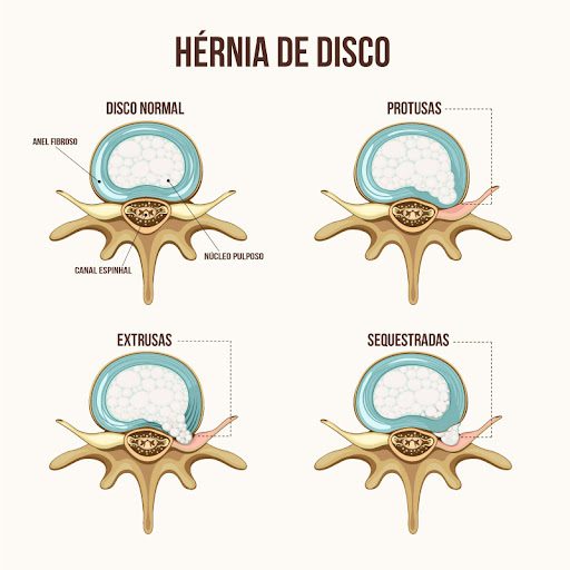 https://fisiomoco.pt/wp-content/uploads/2023/12/hernia-discal.jpg