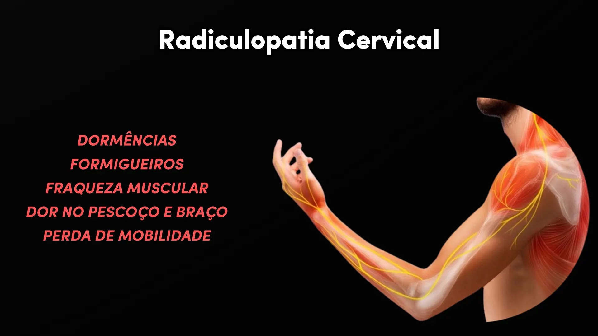 Como Tratar a Radiculopatia Cervical